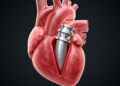 Inverted Graft Technique After Bentall Surgery Triggered Unexpected Outflow Tract Narrowing