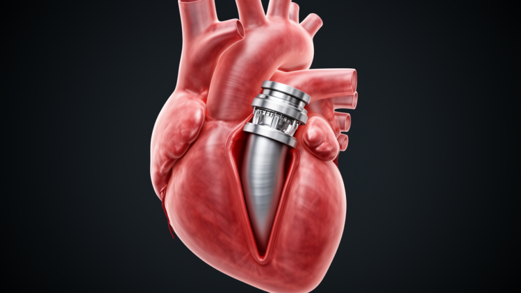 Inverted Graft Technique After Bentall Surgery Triggered Unexpected Outflow Tract Narrowing