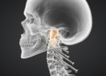 CT scans reveal basilar invagination reshapes screw paths in neck surgery