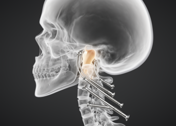 CT scans reveal basilar invagination reshapes screw paths in neck surgery