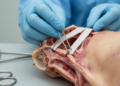 Round and tape sutures hold equally well inside shoulder anchors, cadaver study finds