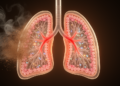 Wood Smoke Particles Trigger Asthma-Like Airway Disease in Mice Through a Sprouty2-Dependent Pathway