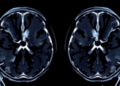 Sharper Prostate MRI Scans May Not Mean Better Cancer Detection, Review Finds