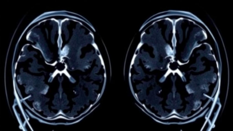 Sharper Prostate MRI Scans May Not Mean Better Cancer Detection, Review Finds