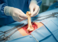 Living Bone Transplants Slowly Heal Devastating Leg Infections, Long-Term Study Finds