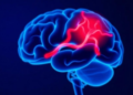 Brain Bleeds Strike About One in Fifty Newborns with Hemophilia, Meta-Analysis Finds