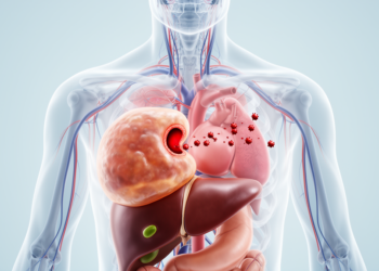 A Giant Liver Cyst, a Hidden Heart Hole and Strokes That Baffled Doctors