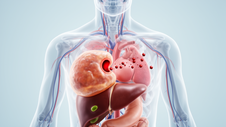 A Giant Liver Cyst, a Hidden Heart Hole and Strokes That Baffled Doctors