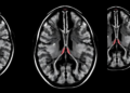 AI Prostate MRI Tool Shows High Sensitivity but Hard Trade-Offs in Real-World Test