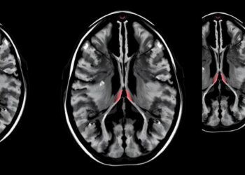 AI Prostate MRI Tool Shows High Sensitivity but Hard Trade-Offs in Real-World Test