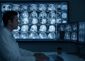 AI Reads Hidden Patterns in Lung CT Scans to Tell Harmless Nodules From Invasive Cancer