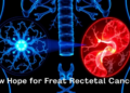 Radiotherapy Meets Immunotherapy: New Hope for Hard-to-Treat Rectal Cancer