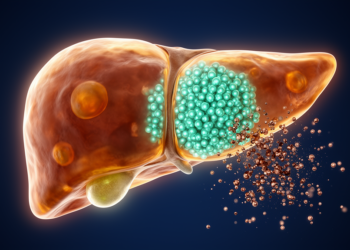 Copper Overload Silences a Key Liver Fat Gene, Pushing Cells Into Ferroptosis in Wilson Disease