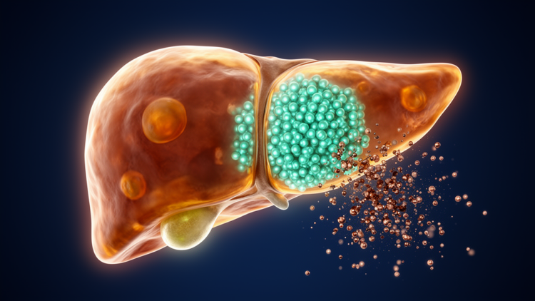 Copper Overload Silences a Key Liver Fat Gene, Pushing Cells Into Ferroptosis in Wilson Disease