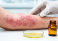 Heat-Killed Bacteria from a Medicinal Mushroom Show Promise Against Eczema-Like Skin Damage