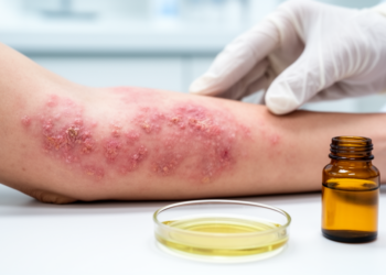 Heat-Killed Bacteria from a Medicinal Mushroom Show Promise Against Eczema-Like Skin Damage