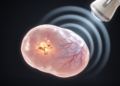 3D Microvascular Ultrasound Reveals Hidden Cancer in a Stable Ovarian Cyst