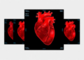 AI Reads Heart Scans to Predict Who Benefits Most from AF Ablation