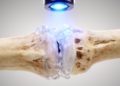 Light-Cured Bone Glue That Mimics Natural Bone Mineral Speeds Fracture Healing