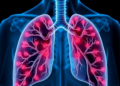 HIV Blinds the Immune System to Lung Cancer Mutations, Study Suggests