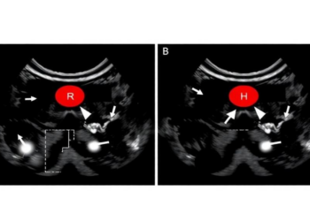 AI Spots Hidden Thyroid Cancer Spread From Ultrasound Scans, Dual-Center Study Shows