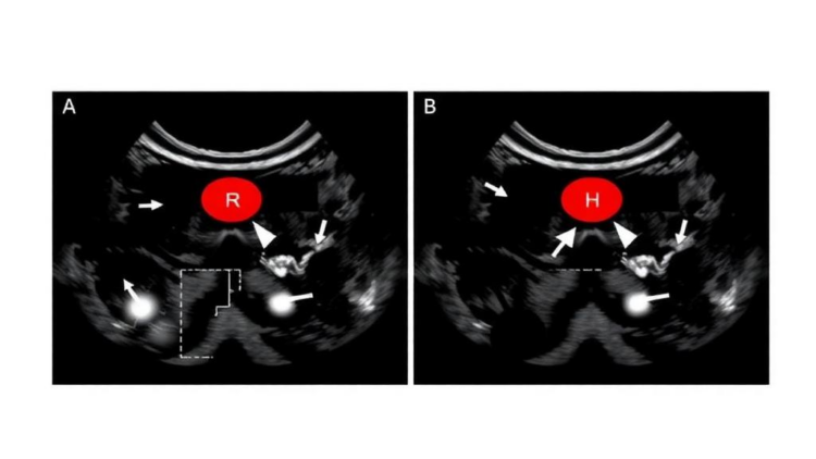 AI Spots Hidden Thyroid Cancer Spread From Ultrasound Scans, Dual-Center Study Shows