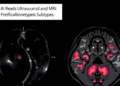 AI Reads Ultrasound and MRI Together to Predict Breast Cancer Subtypes Without a Biopsy