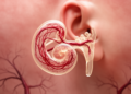 Birthmark Gene May Reach the Inner Ear: Hearing Loss Emerges as an Overlooked Feature of Port-Wine Stains and Sturge-Weber Syndrome