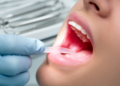 Dissolvable Gum Film Delivers Next-Generation Antibiotic Straight Into Periodontal Pockets
