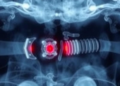 Ultrasound-Shaken Implants Reveal Hidden Bone Infection Pathogens