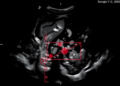 AI Reads Routine Ultrasound Scans to Predict Breast Cancer Spread to Lymph Nodes