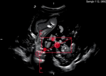 AI Reads Routine Ultrasound Scans to Predict Breast Cancer Spread to Lymph Nodes