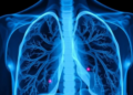 Tuberculosis Rarely Stays in the Lungs, Seven-Year Hospital Study Finds