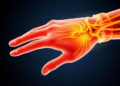 New Statistical Model Captures How Stretching Injures Nerve Fibers
