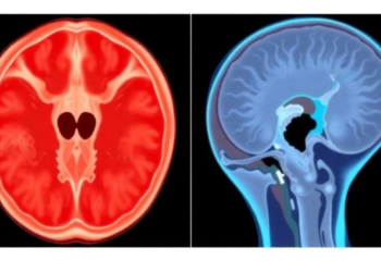 3D CT Scans Reveal Hidden Ear Bone Defects Before Hearing Surgery