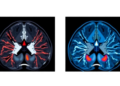 Radiomics Meets MR Cytometry: AI Sharply Improves Breast Tumor Diagnosis on MRI
