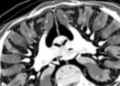 AI Finds Hidden Osteoporosis in Everyday CT Scans, Study Shows