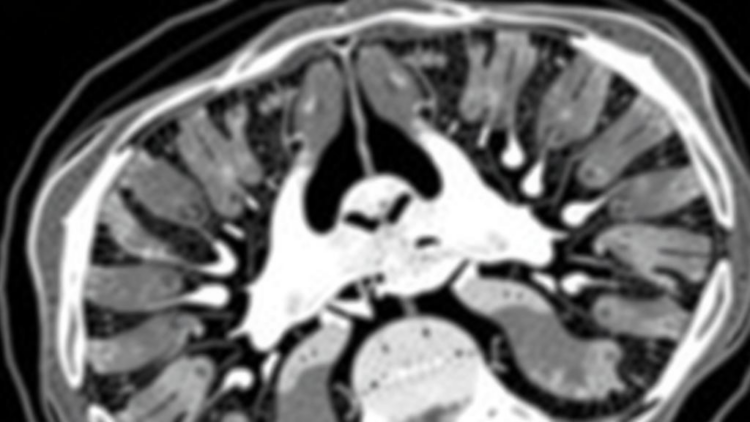 AI Finds Hidden Osteoporosis in Everyday CT Scans, Study Shows