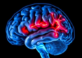 Brain Scan Fingerprints of Parkinson's Emerge Years Before Symptoms Appear