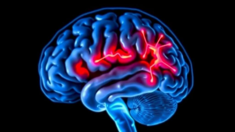 Brain Scan Fingerprints of Parkinson's Emerge Years Before Symptoms Appear