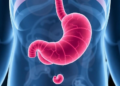 Common Stomach Bacterium Linked to Poorer Survival in Cancer Immunotherapy Patients