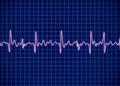 AI Turns a Routine ECG Into a Powerful Predictor of Hidden Heart Artery Disease