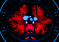 Spectral CT Scan Before Treatment May Predict How Lymphoma Patients Respond