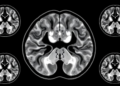 MRI Radiomics Model Predicts Survival in Colorectal Cancer With Liver Metastases