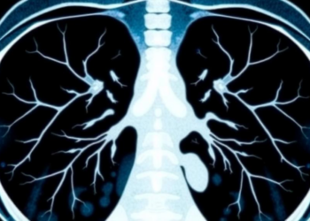 CT Scans Teach Chest X-ray AI to Spot Lung Disease With Far Less Data