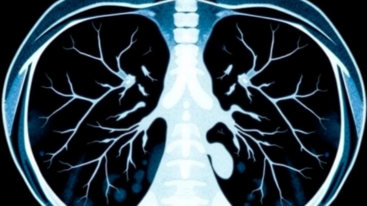 CT Scans Teach Chest X-ray AI to Spot Lung Disease With Far Less Data