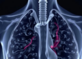 Cigarette Smoke Reprograms Lung Stem Cells, Steering Which Cancer Takes Hold