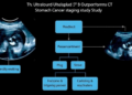 Ultrasound Flowchart Outperforms CT in Stomach Cancer Staging Study