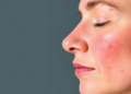 Massive NIH Database Study Probes How Lifestyle, Diet and Treatment Shape Rosacea