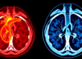 Three Heart Measurements on a Routine CT Scan Could Reveal Hidden Lung Hypertension
